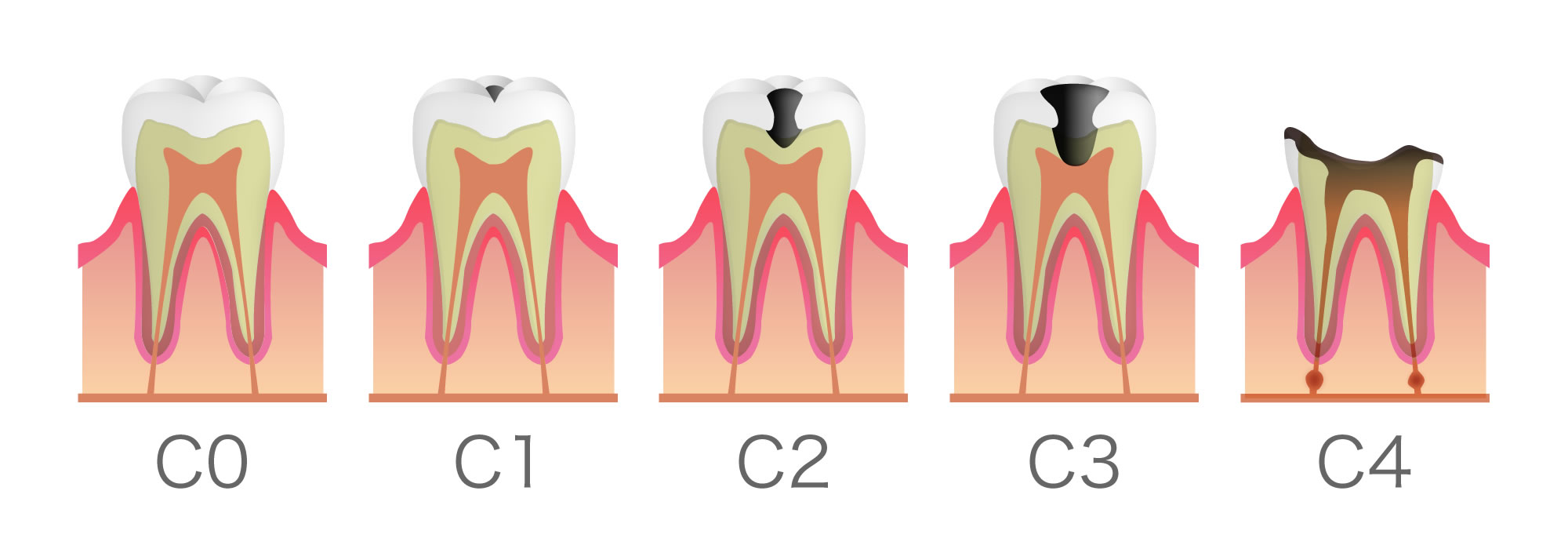 健康な歯の断面図
